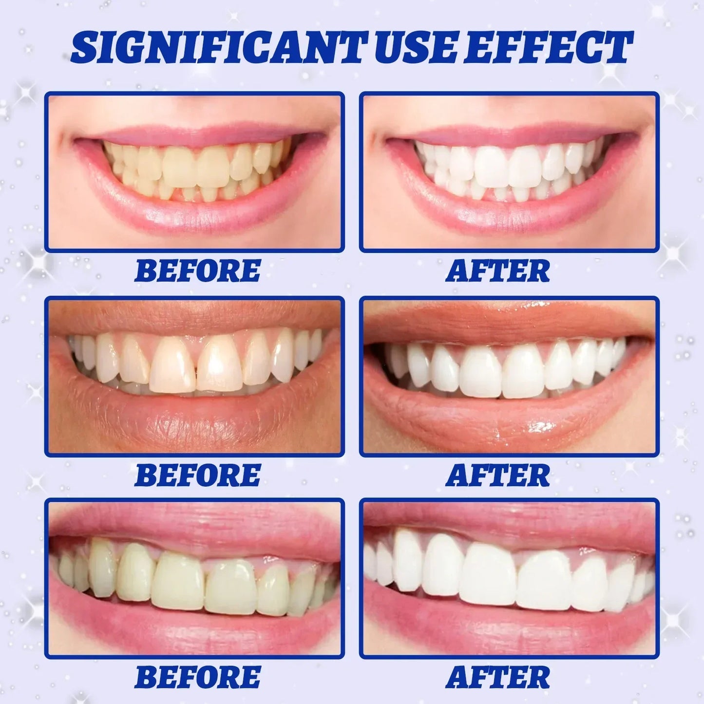 5D Teeth Whitening Strips Gel